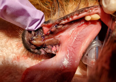 photograph of closure of surgical wound after extraction, debridement, and smoothing of sharp bone.